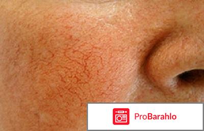 Авен (avene) Антиружер плюс от купероза