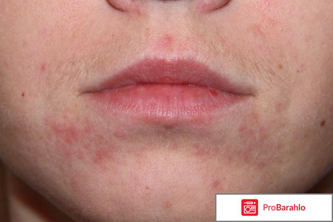 Нано ботокс для лица отрицательные отзывы обман