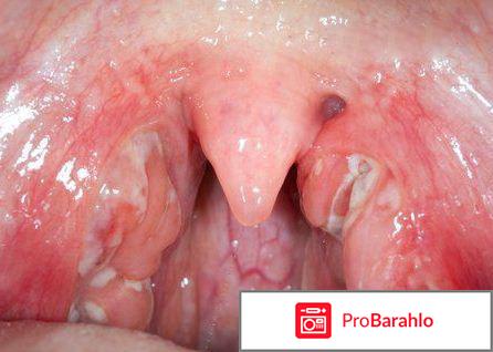 Лакунарная ангина осложнения 