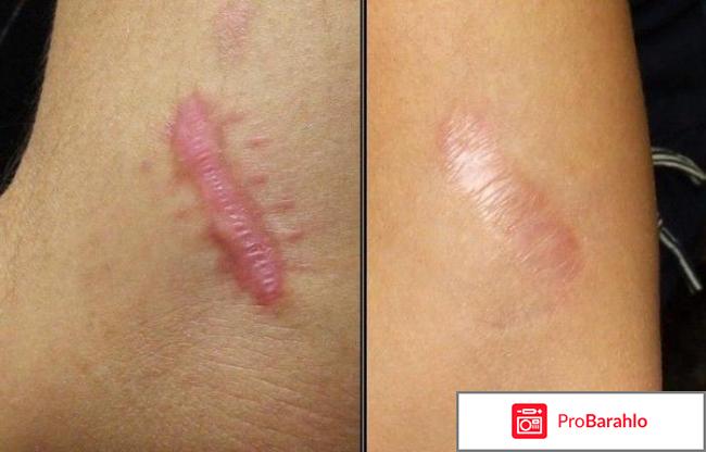 Имофераза отзывы фото 