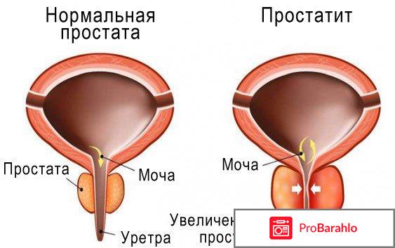 Predstavit (Представит) для лечения простатита 