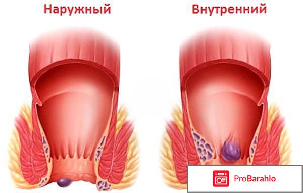 Детралекс 1000 инструкция по применению цена отзывы отрицательные отзывы
