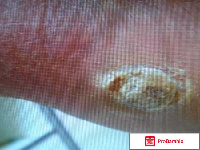 Удаление подошвенных бородавок лазером 