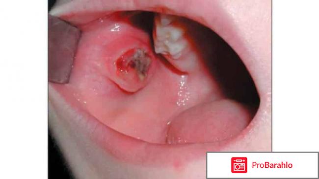 Язва во рту: Лечение в домашних условиях 