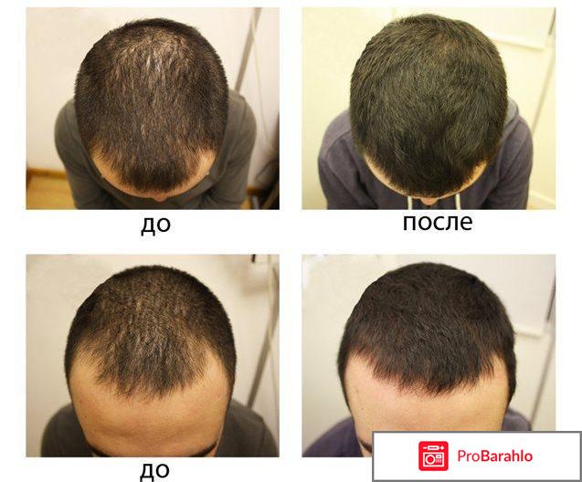 Minoxidil (Миноксидил) реальные отзывы