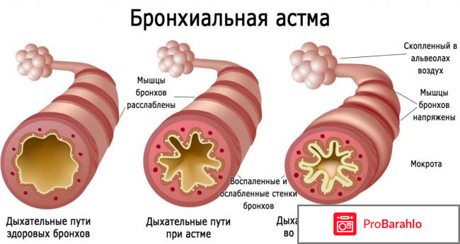 Синглон инструкция по применению цена отзывы 