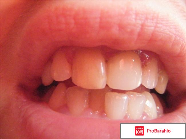 Реставрация зубов отрицательные отзывы