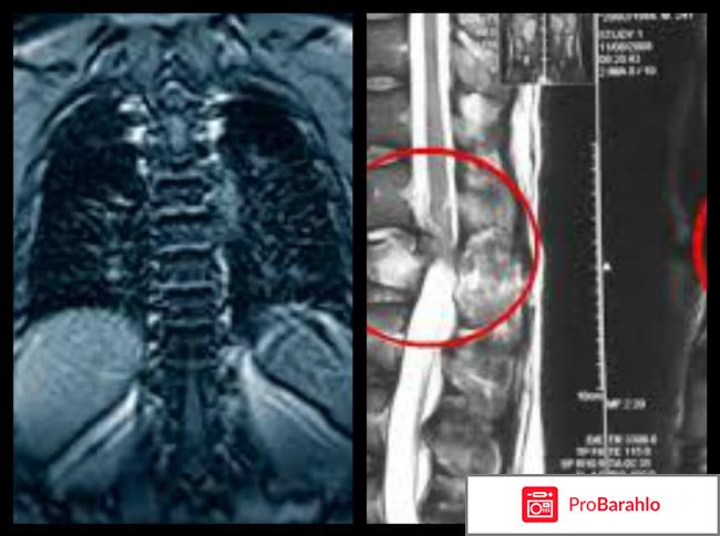 Мрт грудного отдела позвоночника что показывает отрицательные отзывы