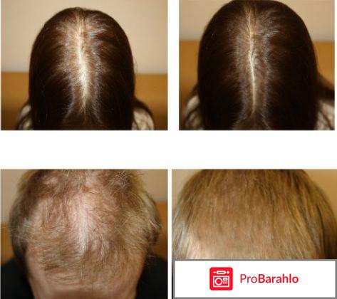 Шампунь алерана для роста отзывы фото