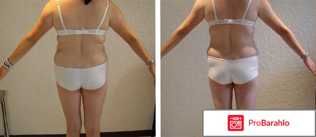 Липолитики от целлюлита отрицательные отзывы