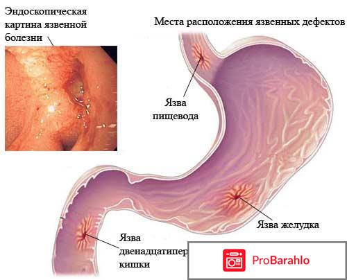 Язва луковицы двенадцатиперстной кишки отрицательные отзывы