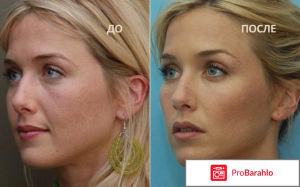 Липолитики отзывы фото до и после лицо 