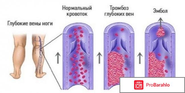 Венза отрицательные отзывы