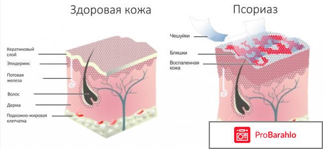 Где лечат от спориаза в одессе 