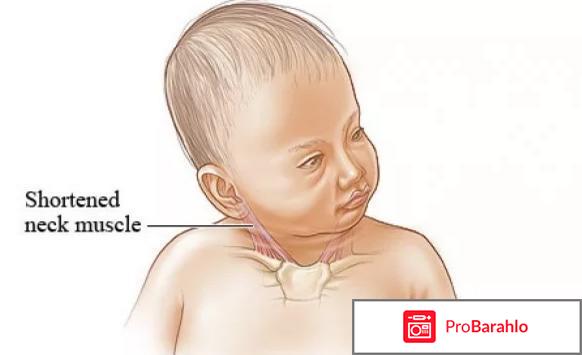 Кривошея у взрослых 