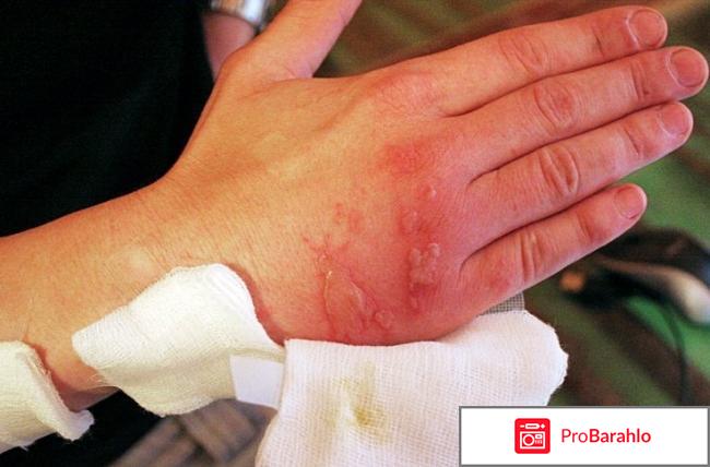 От ожога в домашних условиях 