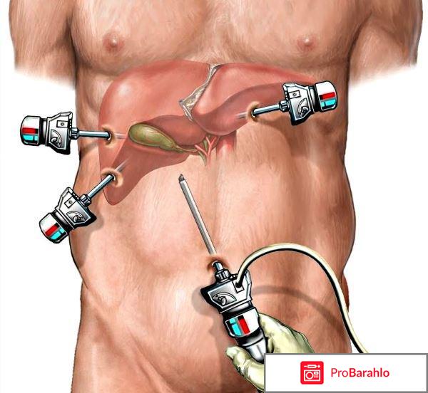 Лапароскопия желчного пузыря отзывы после операции 
