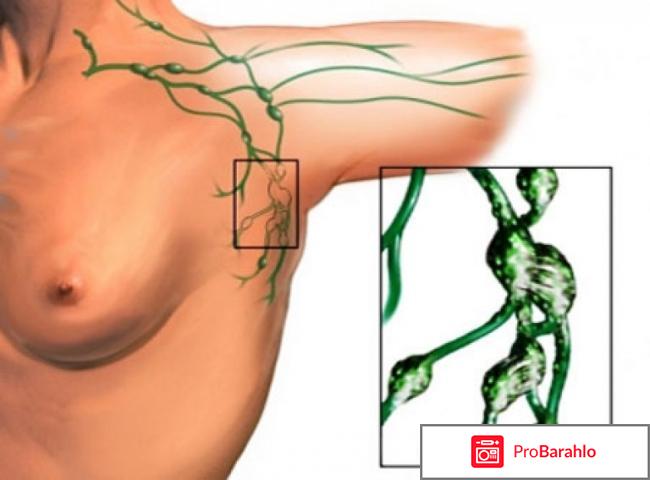 Узи лимфоузлов в подмышке обман