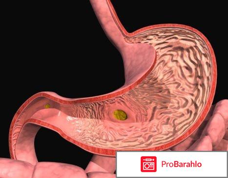 Биогастрон применение при гастрите отрицательные отзывы