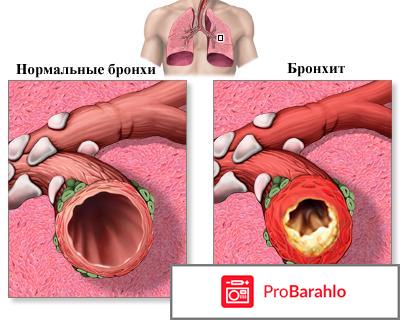 Уколы при бронхите 