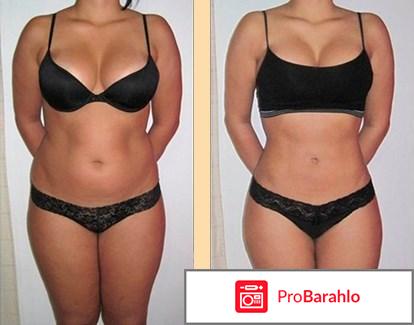 Криолиполиз отзывы фото до и после цена отрицательные отзывы