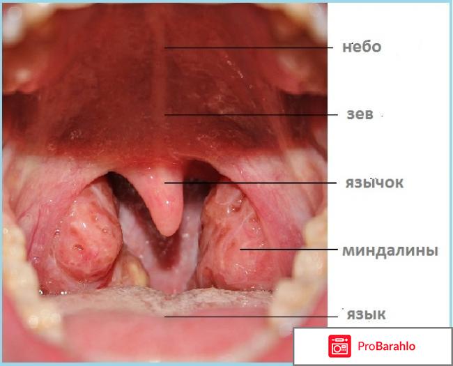 Ангина у ребенка 2 года 