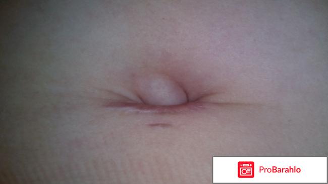 Пирсинг пупка последствия 