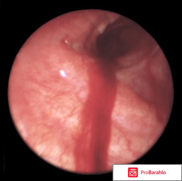 Бронхоскопия отзывы пациентов обман