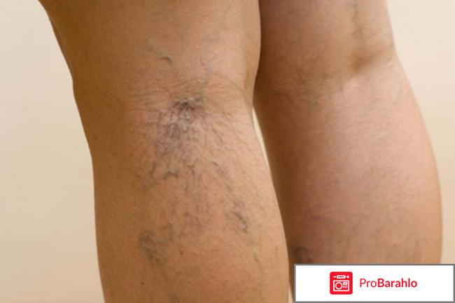 Флебодиа отзывы отрицательные отзывы