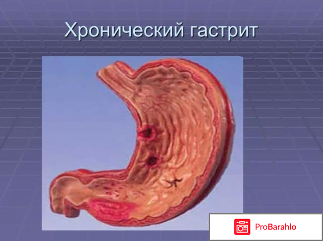 Препараты от гастрита с повышенной кислотностью список 