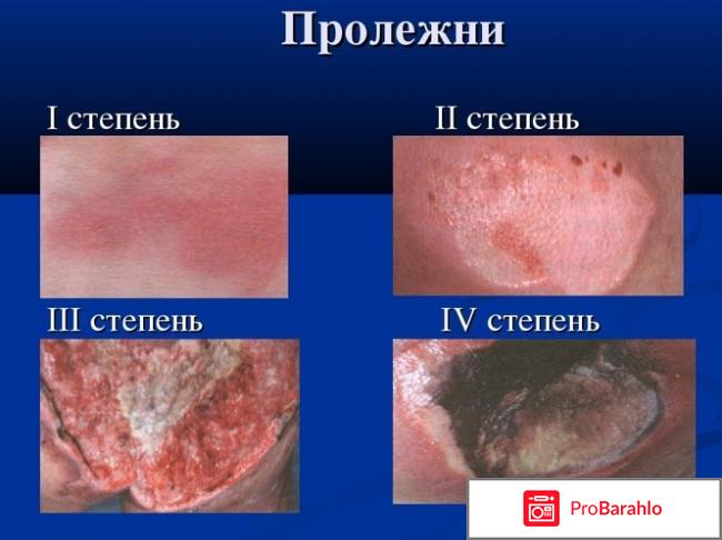 Пролежни: виды, симптомы, лечение, осложнения отрицательные отзывы