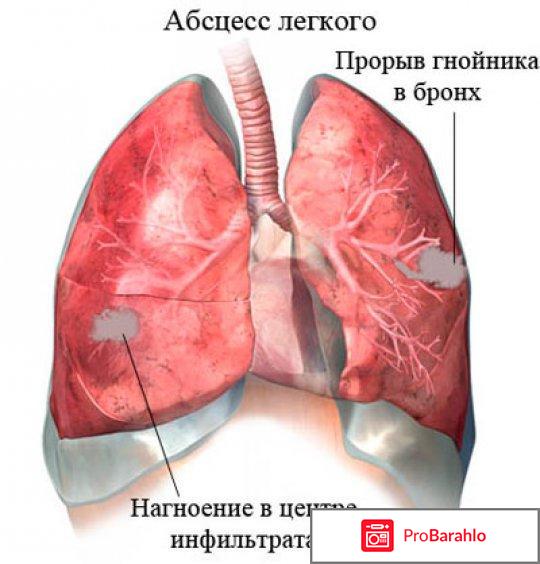 Жидкость в легких: лечение народными средствами отрицательные отзывы