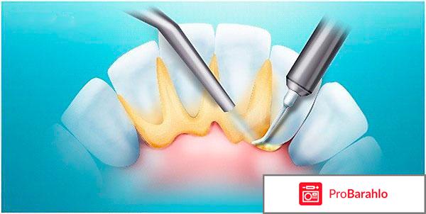Снятие зубного камня отрицательные отзывы
