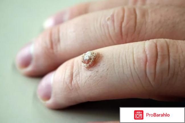 ДУОФИЛМ отрицательные отзывы