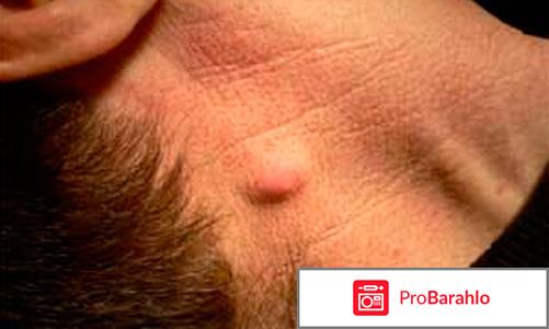 Воспаление волосяной луковицы