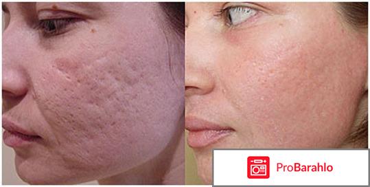 Дермабразия отзывы обман