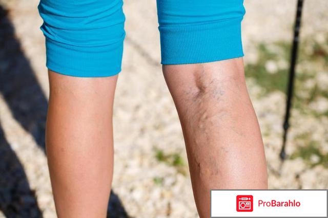 Lifestream nano гель от варикоза отрицательные отзывы