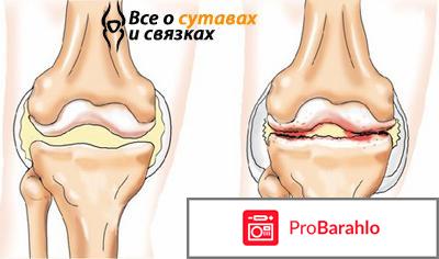 Артропант крем для суставов отзывы 