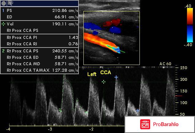 Узи брахиоцефальных сосудов что это обман
