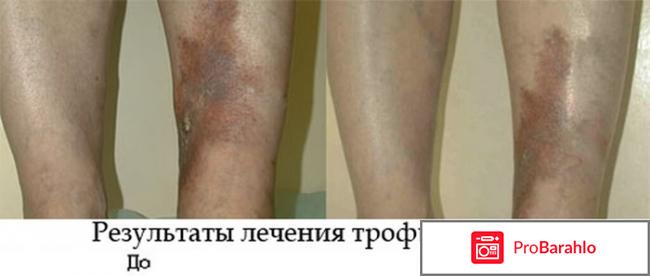 Ируксол мазь купить в Москве в аптеке цена реальные отзывы