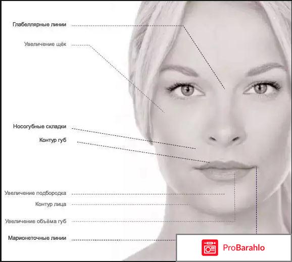 Рестилайн (Restylane) с ледокаином 