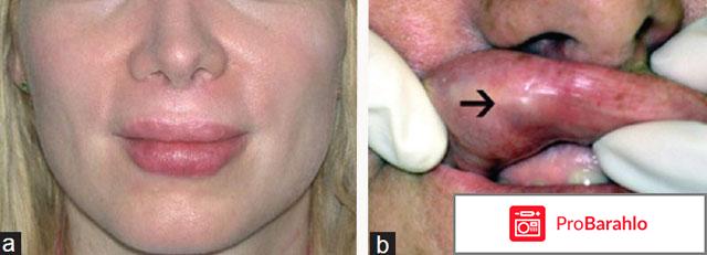 Кислота гиалуроновая в губы отзывы владельцев