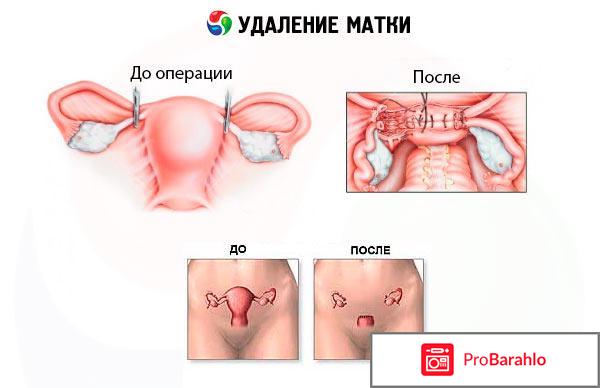 Отзывы женщин после удаления матки 