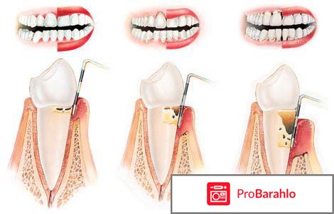 Острый пародонтоз 