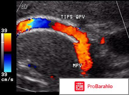 Doppler color обман
