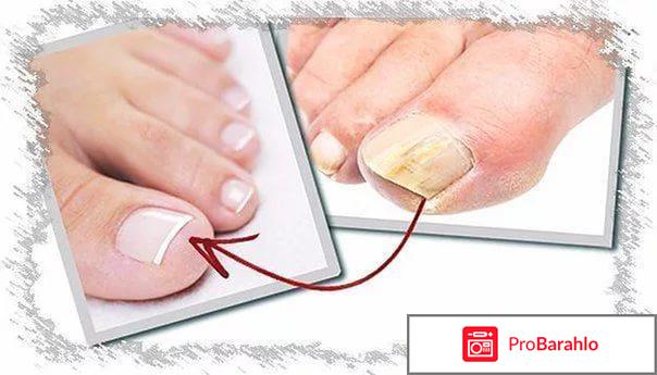 Сангридок от грибка отрицательные отзывы