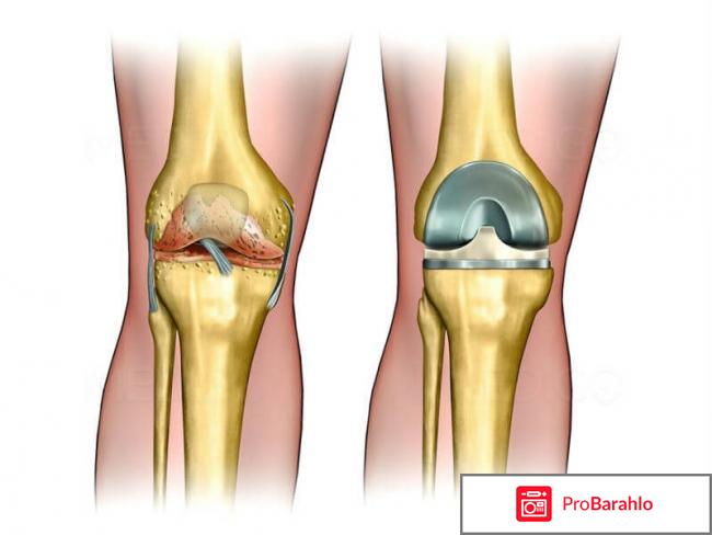 Артропант (Artropant) фото