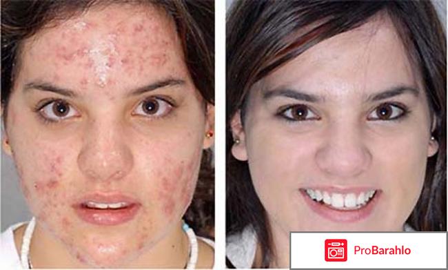 Роаккутан инструкция обман