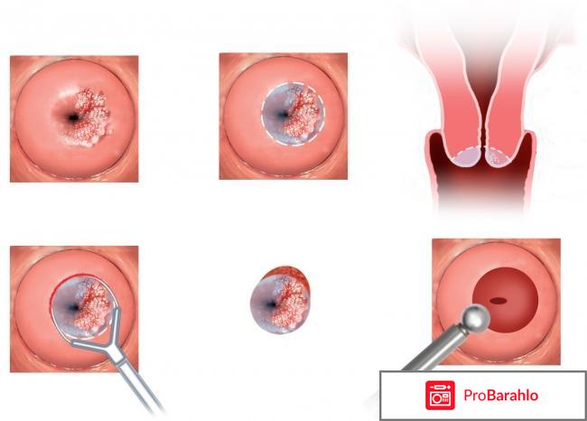 Эрозия шейки матки лечение отрицательные отзывы