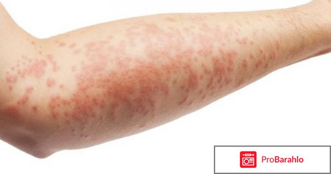 Тримистин мазь инструкция по применению цена отзывы обман